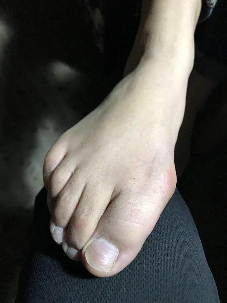 夏天重口味原味臭脚,脚脚上的皮屑清晰可见